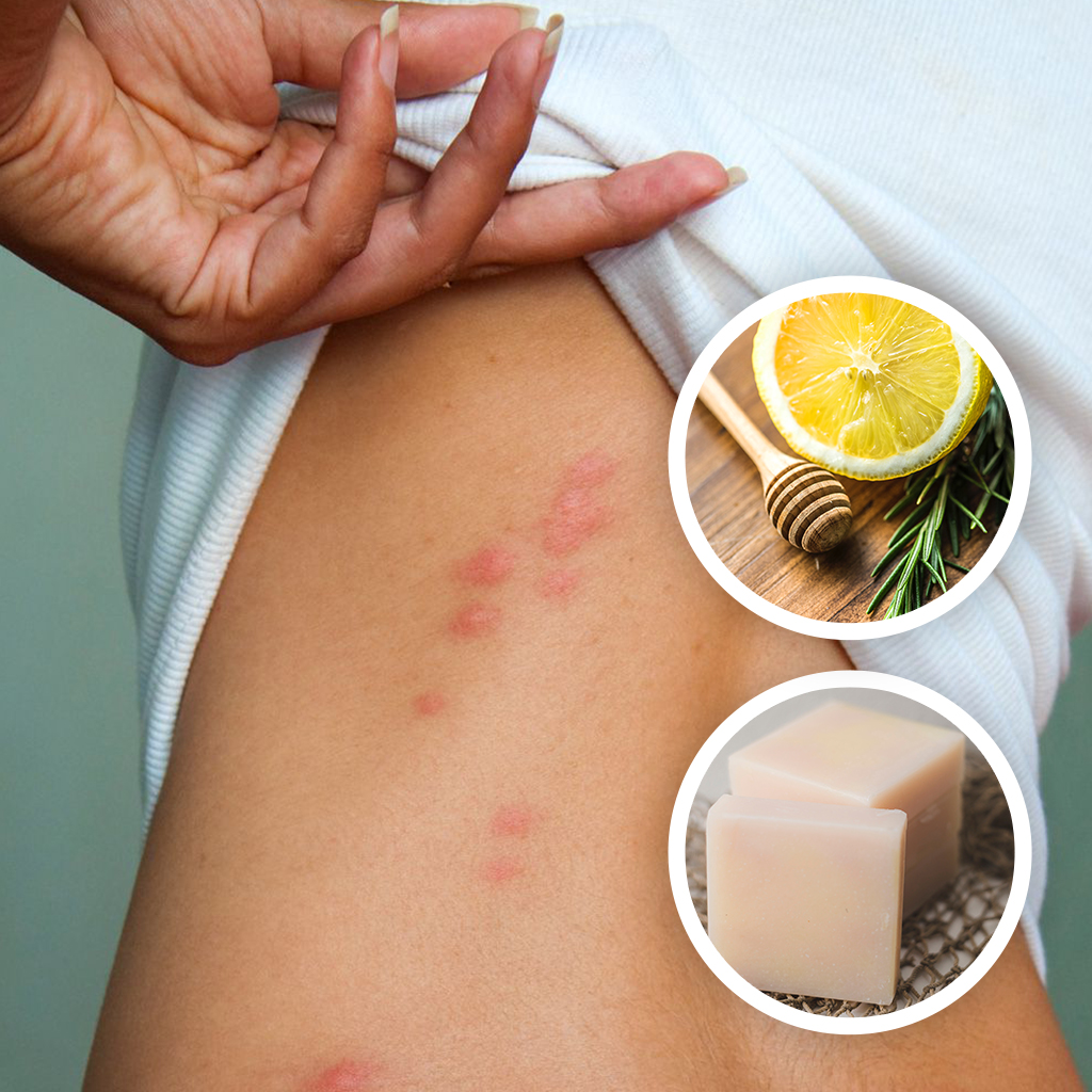 10_Natural_Solutions_How_to_Stop_Bed_Bug_Bites_from_Itching_Home_Remedies_feature