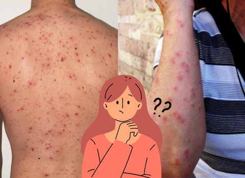 Itchy_and_Red_Comparing_Bed_Bug_Bites_and_Chicken_Pox_Rash_1