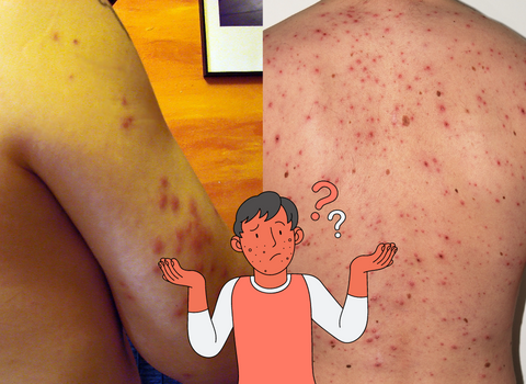 Itchy_and_Red_Comparing_Bed_Bug_Bites_and_Chicken_Pox_Rash_2