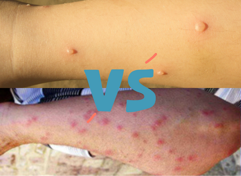 Itchy_and_Red_Comparing_Bed_Bug_Bites_and_Chicken_Pox_Rash_3