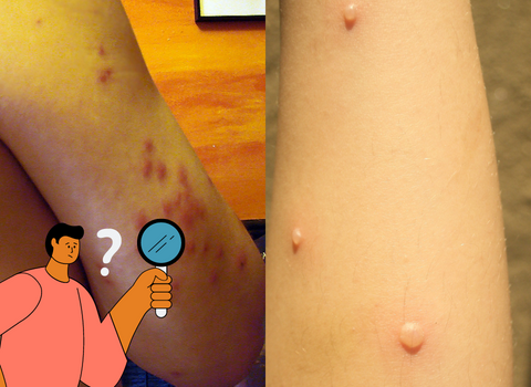 Itchy_and_Red_Comparing_Bed_Bug_Bites_and_Chicken_Pox_Rash_4