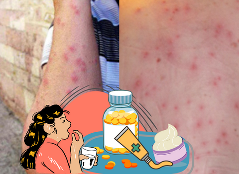 Itchy_and_Red_Comparing_Bed_Bug_Bites_and_Chicken_Pox_Rash_5