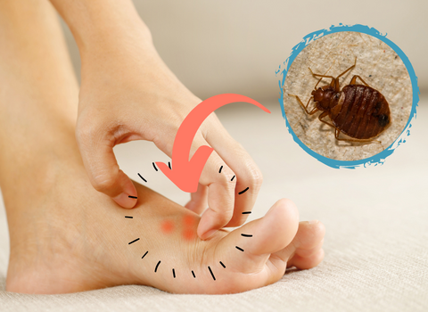 How_to_Get_Rid_of_Bed_Bugs_Bite_Marks_1
