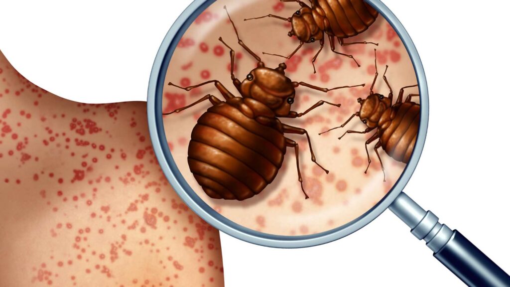 Do-Pimples-and-Bed-Bug-Bites-have-Similar-Symptoms