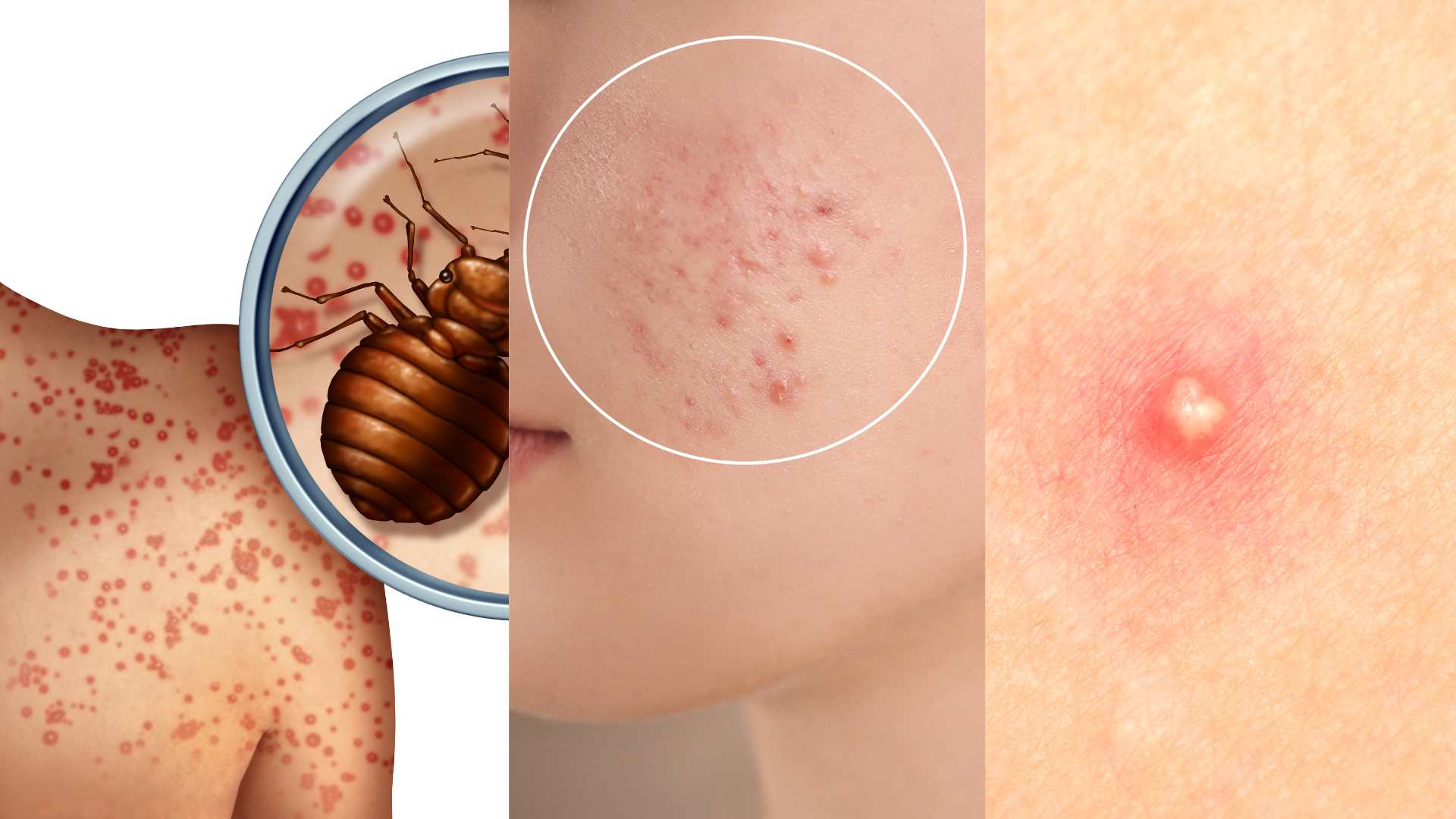 Pimples VS Bed Bug Bites VS Acne